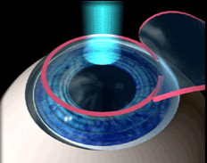 Photoablation laser